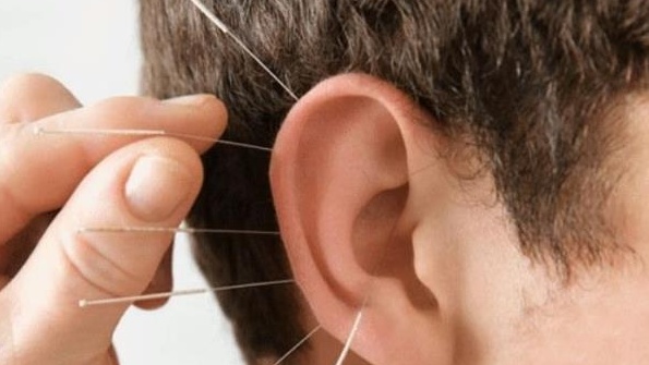 Phương pháp nhĩ châm là gì? Liệu trình chữa trị như thế nào? 3