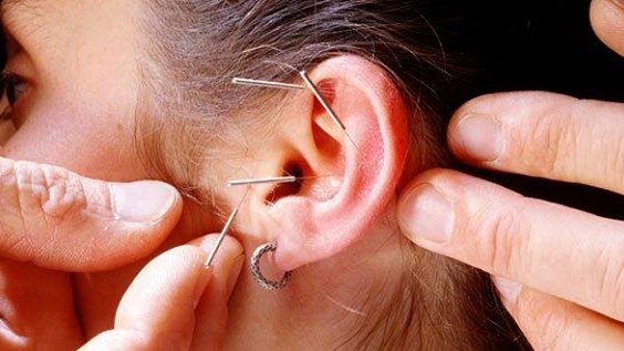 Phương pháp nhĩ châm là gì? Liệu trình chữa trị như thế nào? 4