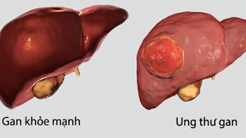 Phương pháp xạ trị trong chọn lọc có ưu điểm gì? 1