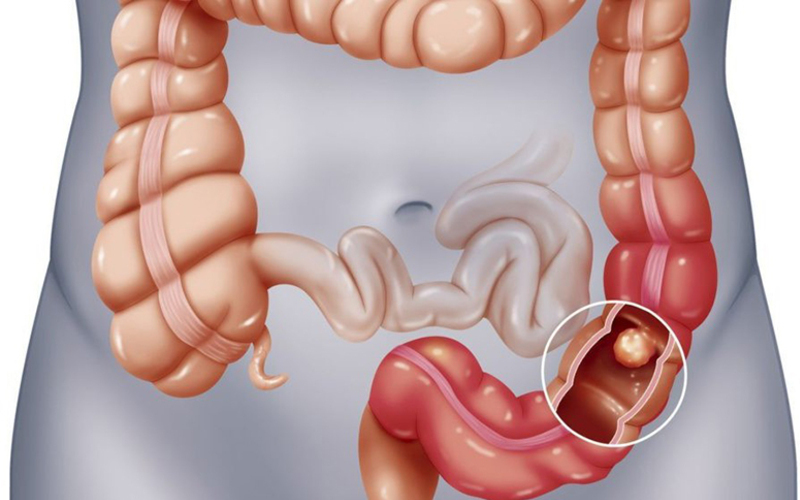 Polyp đại tràng sigma 5mm có to không là thắc mắc của rất nhiều người