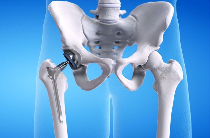 Quá trình phục hồi chức năng sau thay khớp háng diễn ra như thế nào? 1