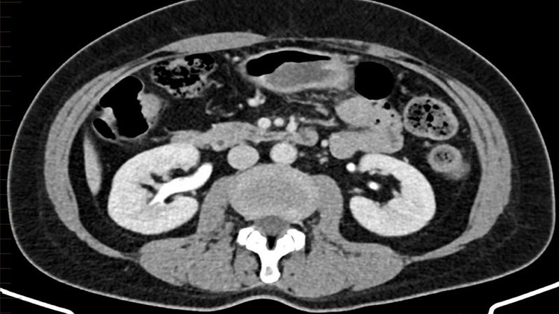 Quy trình chụp CT Scanner hệ tiết niệu chi tiết nhất 1