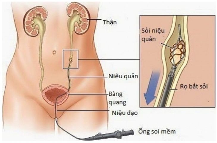 quy-trinh-thuc-hien-ca-mo-noi-soi-soi-than.jpg