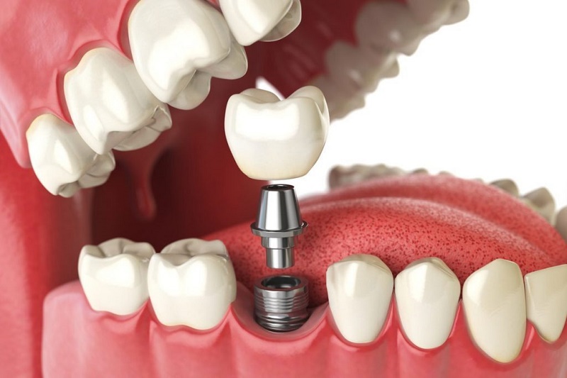 Quy trình trồng răng Implant như thế nào? Những thông tin cần biết 1