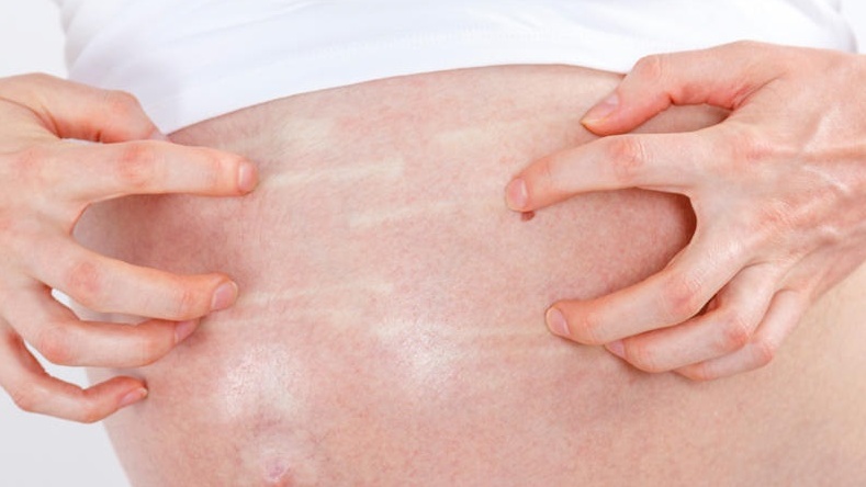 Rạn da bị ngứa: Nguyên nhân và cách xử trí - Nhà thuốc FPT Long Châu