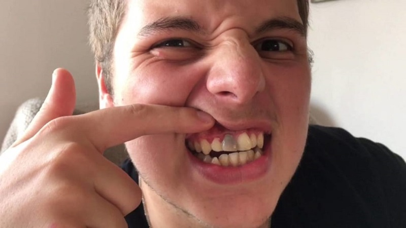 Răng bị đen trên bề mặt: Nguyên nhân, hệ lụy và cách can thiệp 1