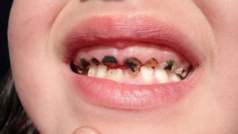 Răng bị đen trên bề mặt: Nguyên nhân, hệ lụy và cách can thiệp 2