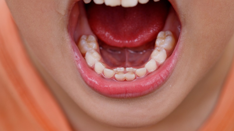 Răng dị dạng: Khái niệm, phân loại và cách can thiệp 1