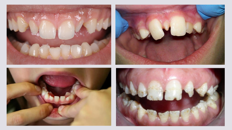 Răng dị dạng: Khái niệm, phân loại và cách can thiệp 2