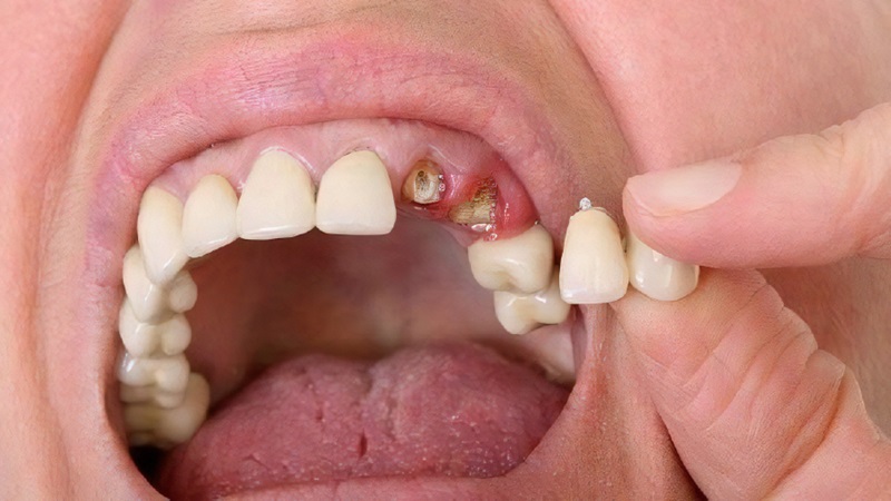 Răng gãy còn chân: Nguyên nhân, tác hại và giải pháp can thiệp 1
