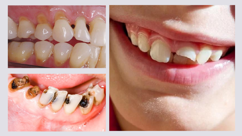 Răng gãy còn chân: Nguyên nhân, tác hại và giải pháp can thiệp 5