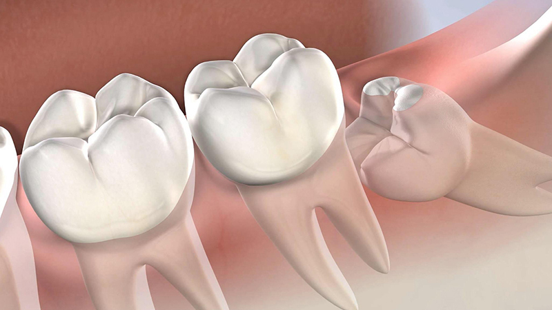 Răng số 8 là răng gì? Có nên nhổ răng số 8 không? 1