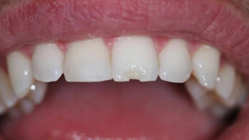 Răng sứ bị mẻ: Nguyên nhân, ảnh hưởng và cách phòng tránh 1