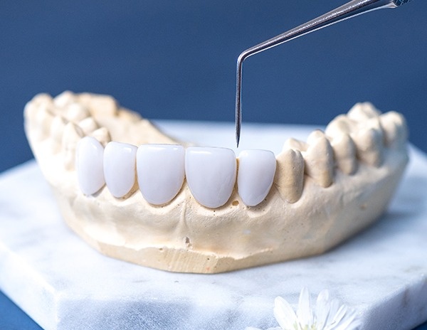 Răng sứ Dmax là gì? Bọc răng sứ Dmax có tốt không? 1