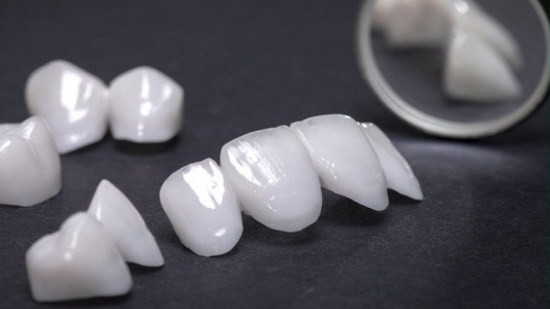Răng sứ venus và tất tần tật thông tin bạn cần biết 1