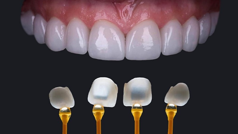 Răng sứ venus và tất tần tật thông tin bạn cần biết 1