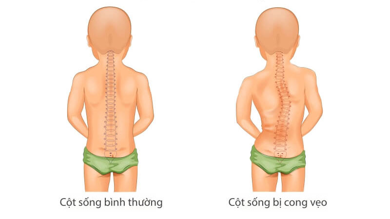 Rối loạn cong cột sống là gì? Có chữa được không? 2