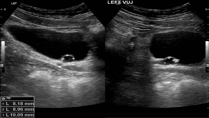 Sa lồi niệu quản: Dấu hiệu, nguyên nhân, chẩn đoán và can thiệp 2