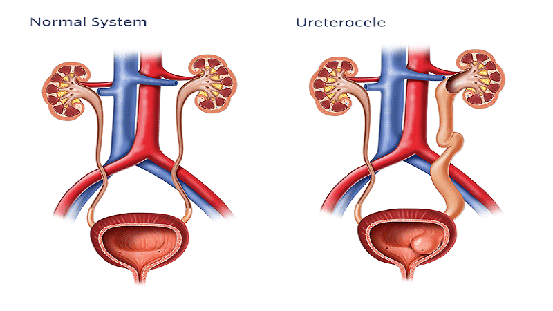 Sa lồi niệu quản: Dấu hiệu, nguyên nhân, chẩn đoán và can thiệp 5