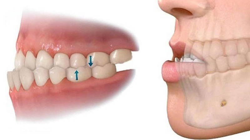 Sai khớp cắn loại 3: Nguyên nhân và cách xử lý 1
