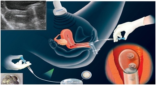 Sau chuyển phôi 7 ngày thử que có kết quả chưa? 1