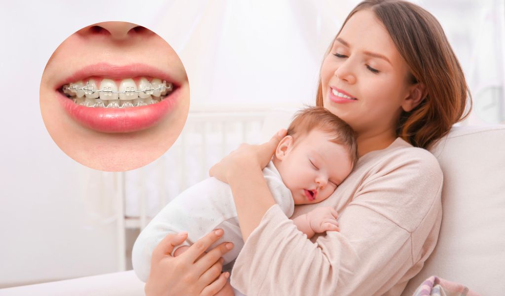 Hỏi đáp: Sau sinh bao lâu thì niềng răng được? - Nhà thuốc FPT Long Châu
