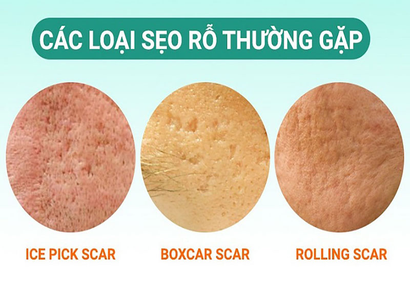 Sẹo rỗ là gì? Kinh nghiệm trị sẹo rỗ lâu năm không phải ai cũng biết 2