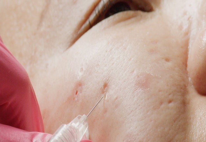 Sẹo rỗ là gì? Kinh nghiệm trị sẹo rỗ lâu năm không phải ai cũng biết 6