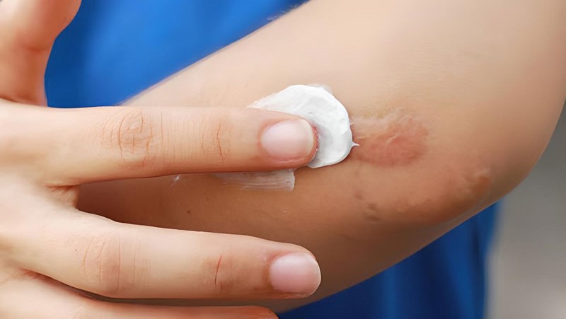 Sẹo thâm là gì? Cách làm mờ sẹo thâm hiệu quả 5