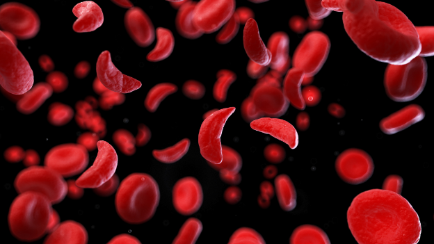 sickle-cell-disease-la-gi-nguyen-nhan-va-trieu-chung-benh 1