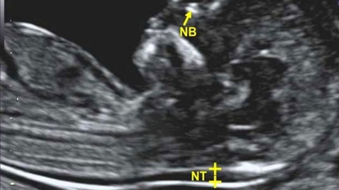 Siêu âm 2D có đo được độ mờ da gáy không? Có chính xác không? 2