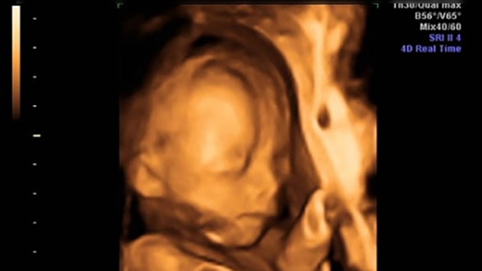 Siêu âm 4D là gì? Siêu âm 4D bị sứt môi phải làm gì? 1