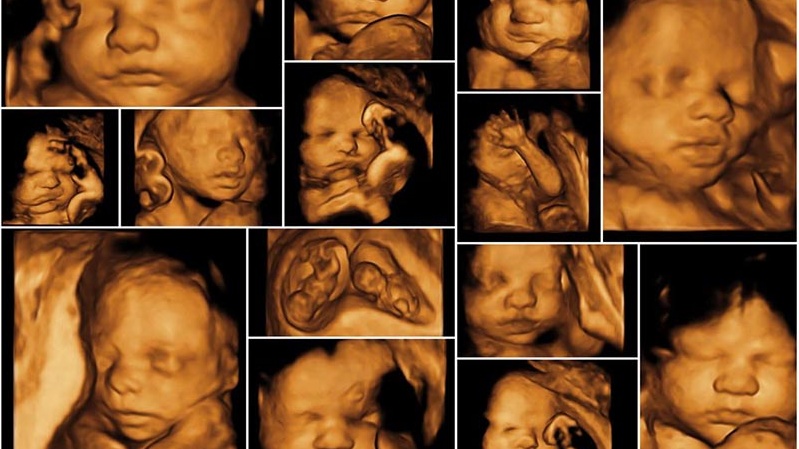 Siêu âm 4D là gì? Siêu âm 4D bị sứt môi phải làm gì? 2