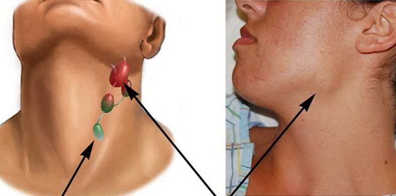 Siêu âm hạch cổ phát hiện bệnh lý gì? Khi nào cần siêu âm hạch cổ? 3