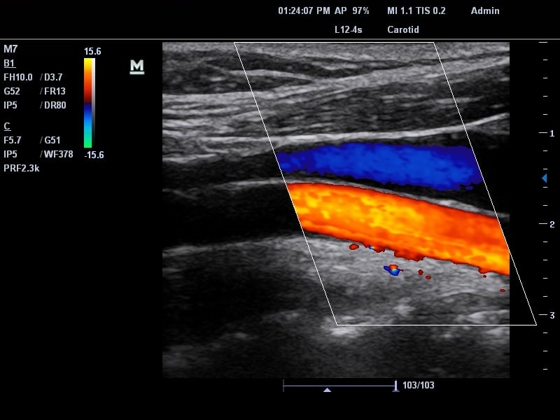 Siêu âm mạch máu chi dưới để làm gì? Khi nào cần siêu âm mạch máu chi dưới? 4