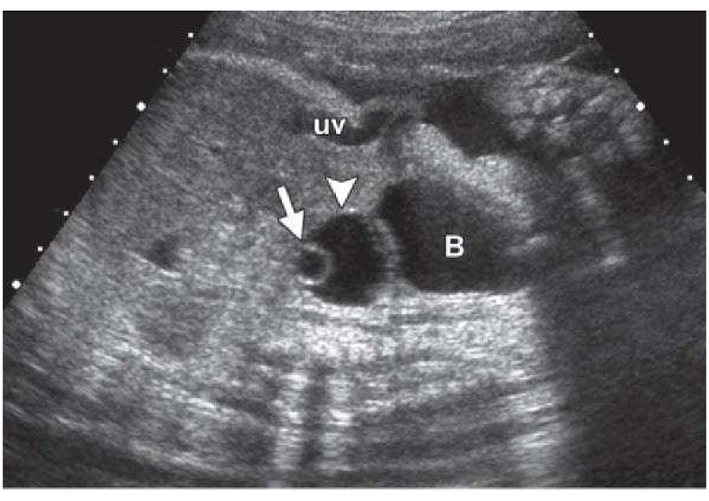 siêu âm thấy nang trống âm buồng trứng