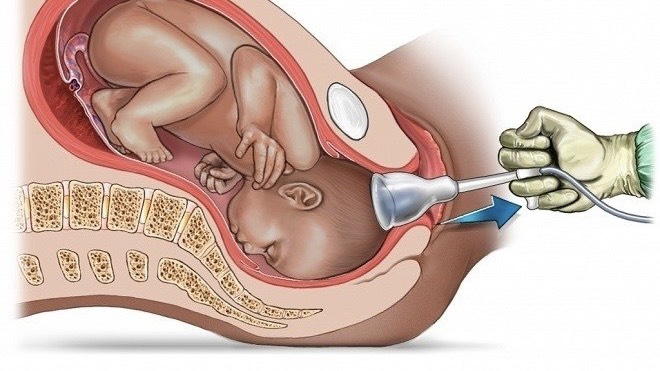 sinh-con-bang-giac-hut-loi-ich-va-rui-ro-can-biet 1