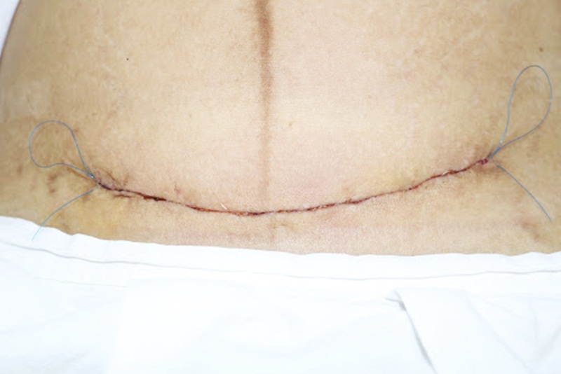 Sinh mổ là gì? Những điều cần biết về quá trình mổ lấy thai 5