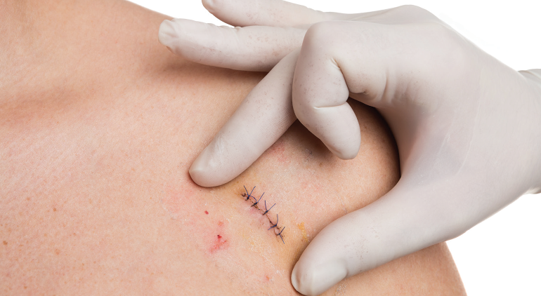 Sinh thiết da là gì? Sinh thiết da bao lâu có kết quả? 3