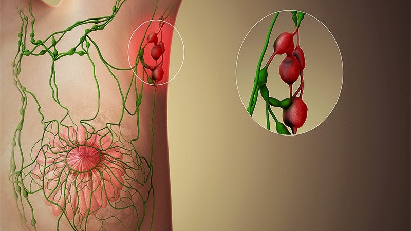 sinh-thiet-hach-gac-cua-co-y-nghia-nhu-the-nao-trong-ung-thu-vu 1