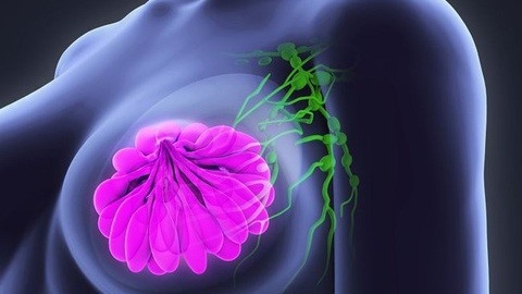 sinh-thiet-hach-gac-cua-co-y-nghia-nhu-the-nao-trong-ung-thu-vu 2