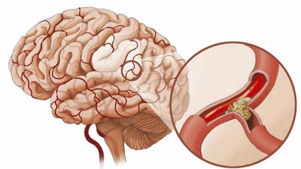 Sinh thiết não là gì? Có nguy hiểm không? 3