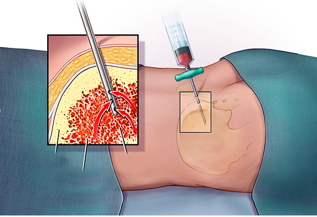 Sinh thiết tủy xương là gì? Quy trình và những điều cần lưu ý khi thực hiện 2