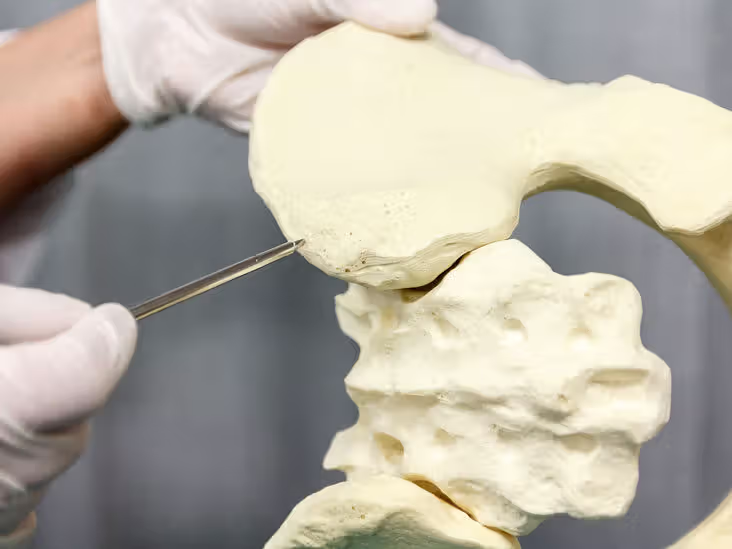 Sinh thiết tủy xương là gì? Quy trình và những điều cần lưu ý khi thực hiện 3