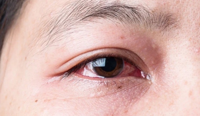 Mắt đỏ khi bị Covid có thể là triệu chứng mới cần lưu ý 2