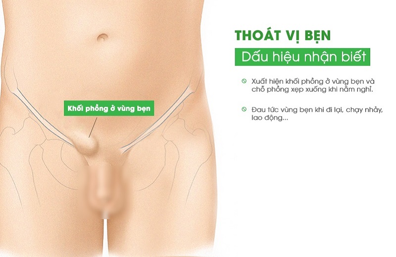 Mổ thoát vị bẹn bao lâu thì lành? Cùng những giải đáp xung quanh 1