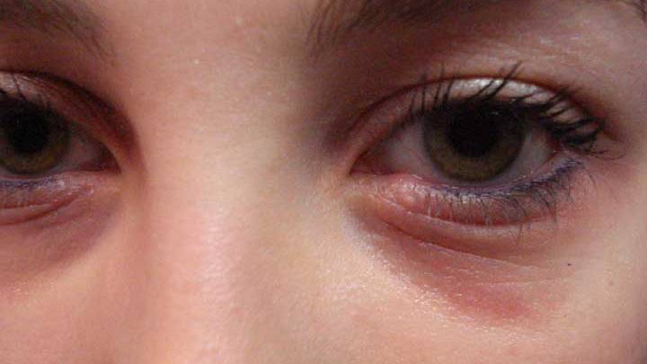 Một đêm mất ngủ khiến mắt thâm quầng, làn da trở nên nhợt nhạt và thiếu sức sống