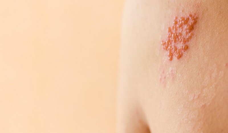 Liệt mặt vĩnh viễn do chủ quan khi bị Zona tai 1