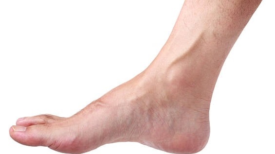 Bàn chân lõm sâu là gì? Nhận biết bàn chân lõm sâu 2