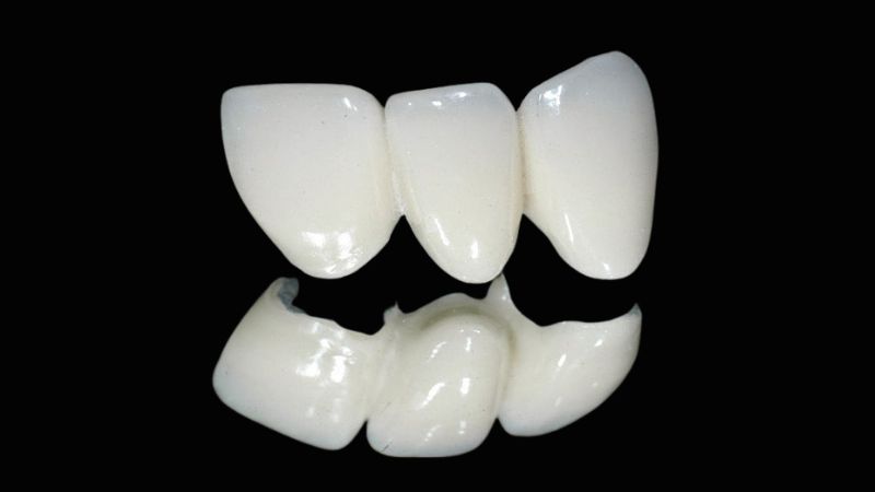 Bọc răng sứ và 8 lợi ích bạn nên biết trước khi thực hiện 4